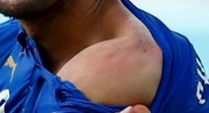 Il segno del morso di Suarez sulla spalla di Chiellini