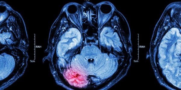 embolia cerebrale