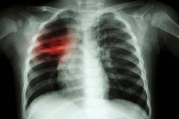 polmonite a Brescia: oltre 150 casii. sintomi, cure e prevenzione