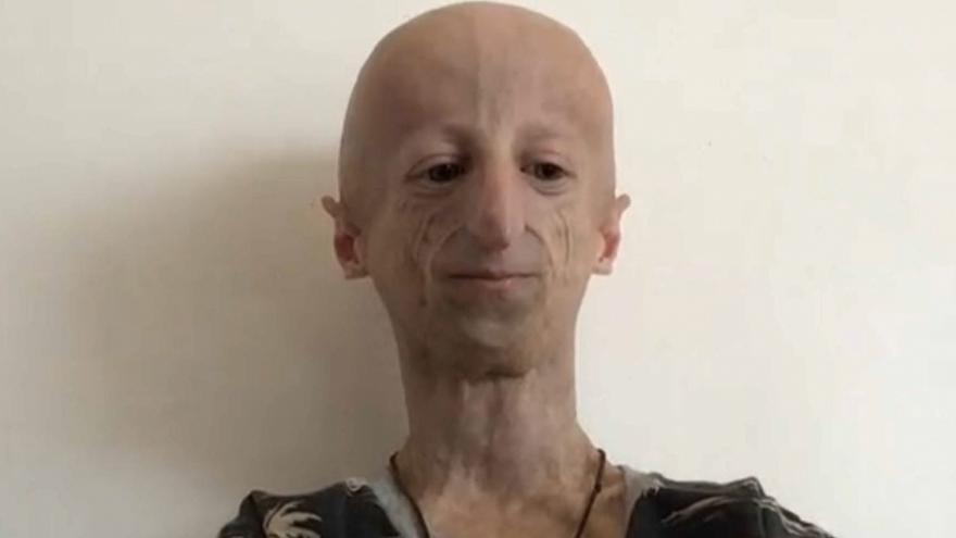 Sammy Basso operato progeria e malattia come sta