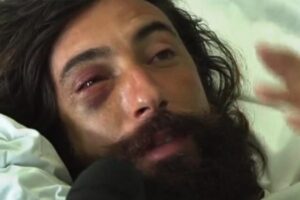 Vittorio Brumotti aggredito a Trani condizioni di salute